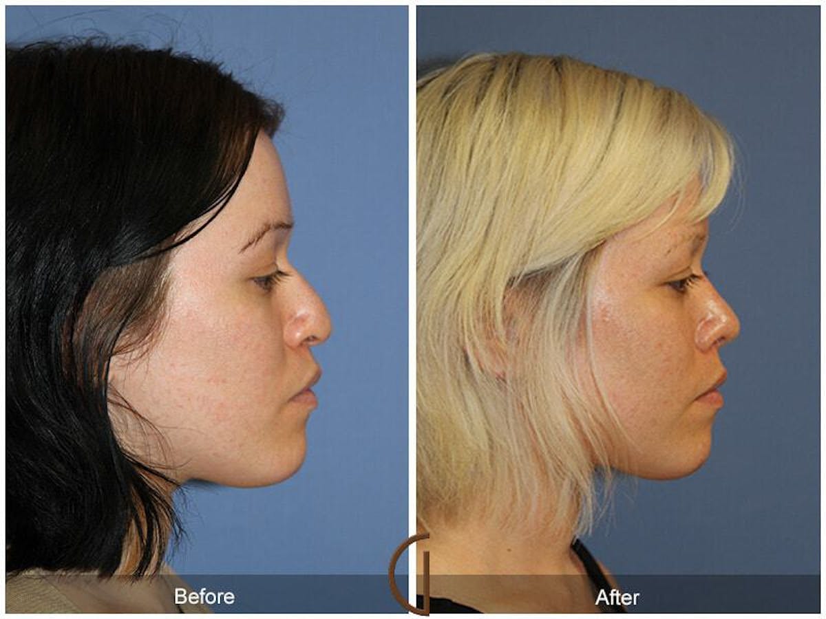 Female Rhinoplasty Before & After Gallery - Patient 168404 - Image 3