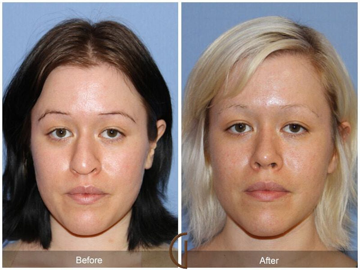 Female Rhinoplasty Before & After Gallery - Patient 168404 - Image 2