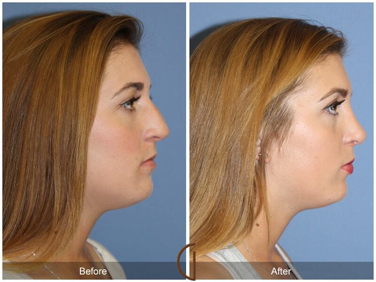 Female Rhinoplasty Before & After Gallery - Patient 394951 - Image 3