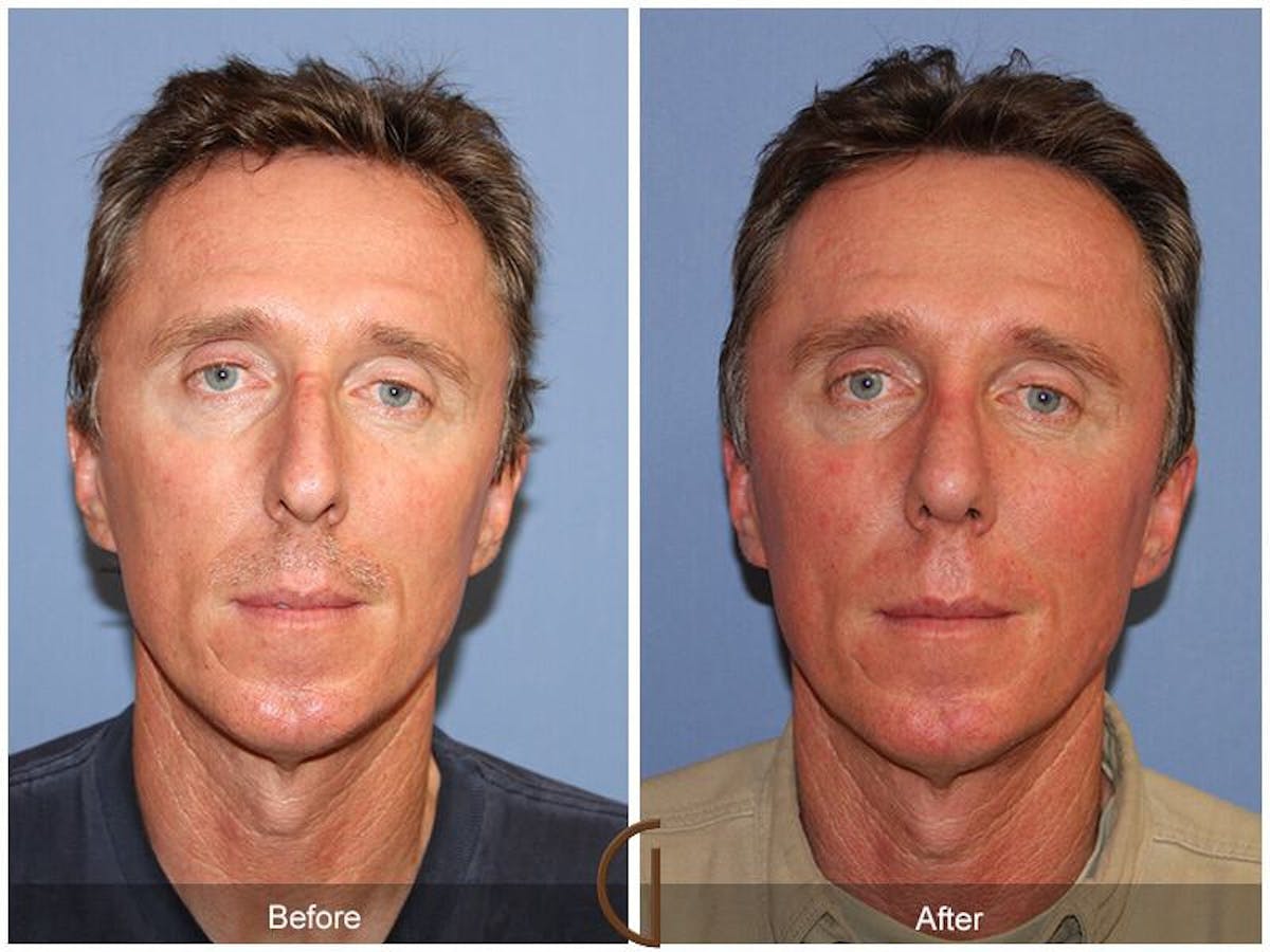 Rhinoplasty Before & After Gallery - Patient 370918 - Image 2