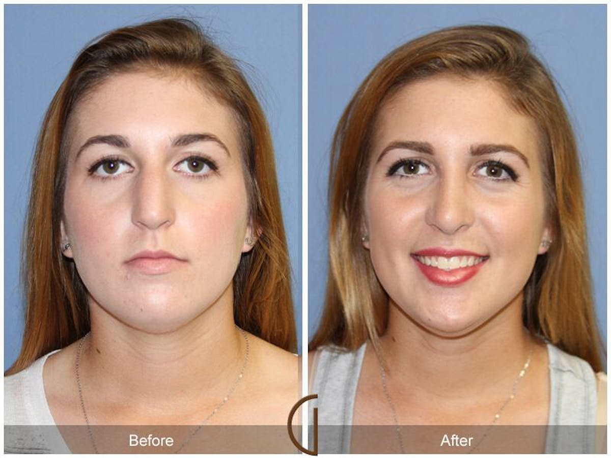 Female Rhinoplasty Before & After Gallery - Patient 394951 - Image 2