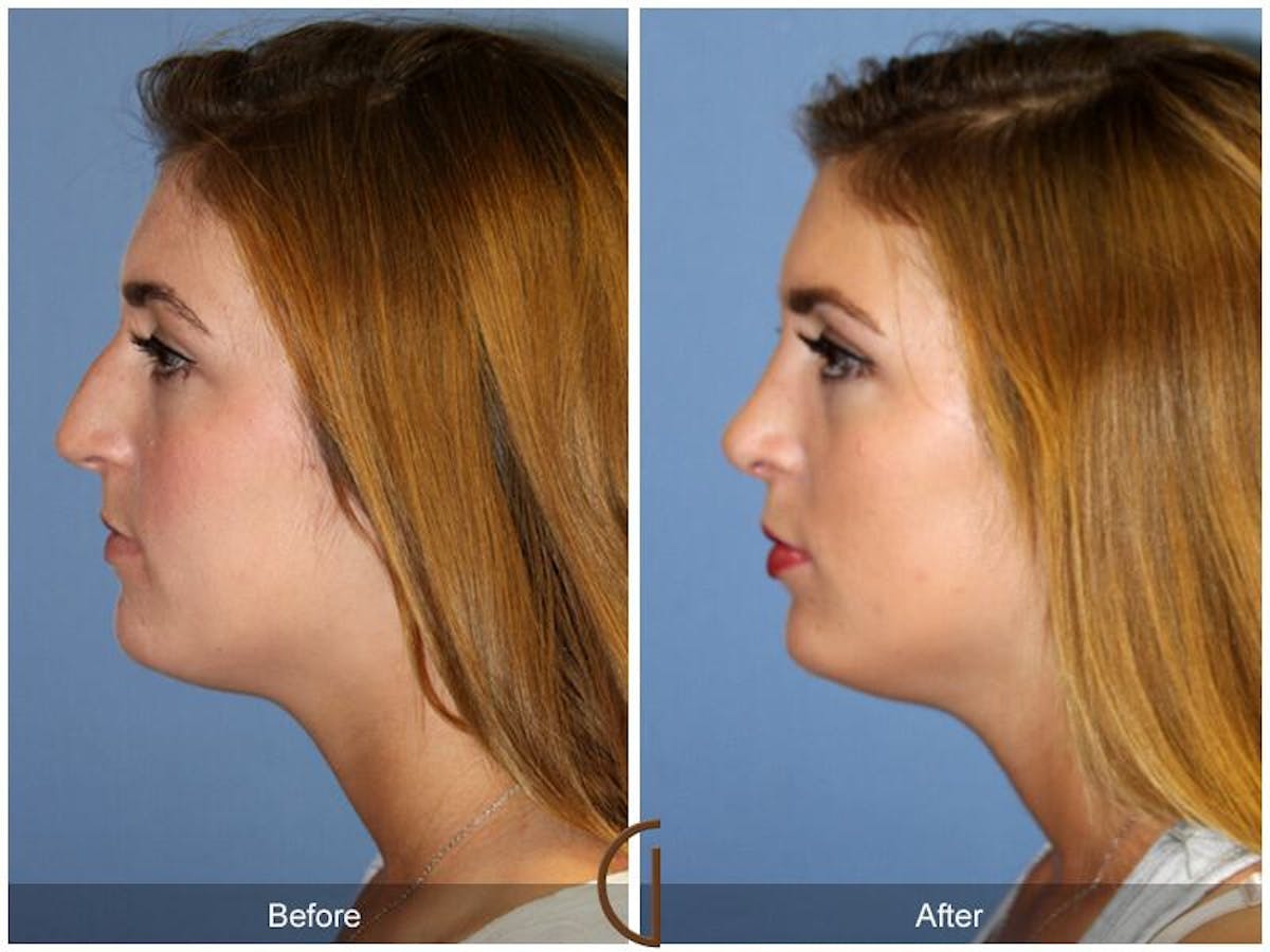 Female Rhinoplasty Before & After Gallery - Patient 394951 - Image 1