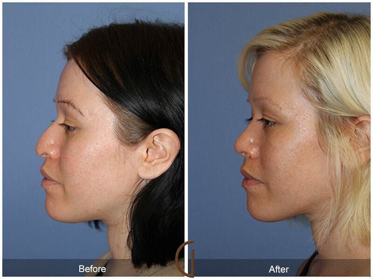 Female Rhinoplasty Before & After Gallery - Patient 168404 - Image 1