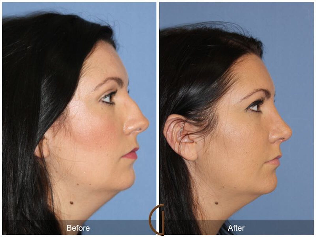 Female Rhinoplasty Before & After Gallery - Patient 332648 - Image 3