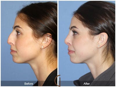 Female Rhinoplasty Before & After Gallery - Patient 613022 - Image 1