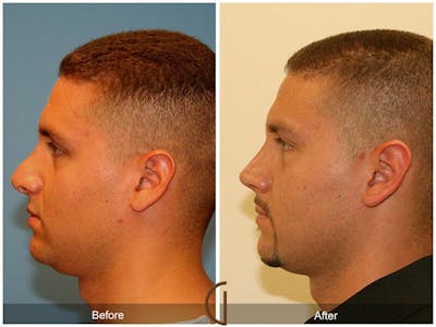 Revision Rhinoplasty Before & After Gallery - Patient 259199 - Image 1