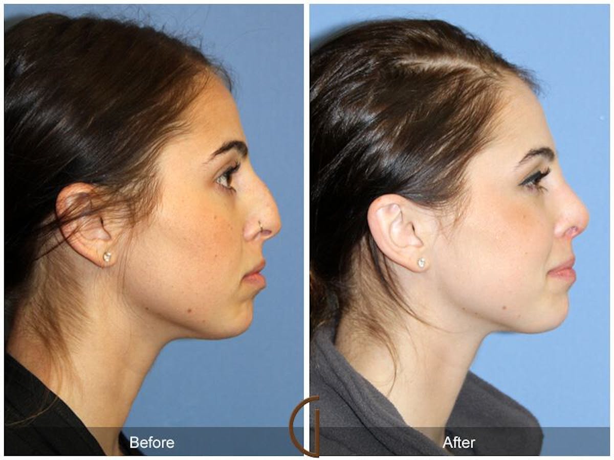 Female Rhinoplasty Before & After Gallery - Patient 613022 - Image 3
