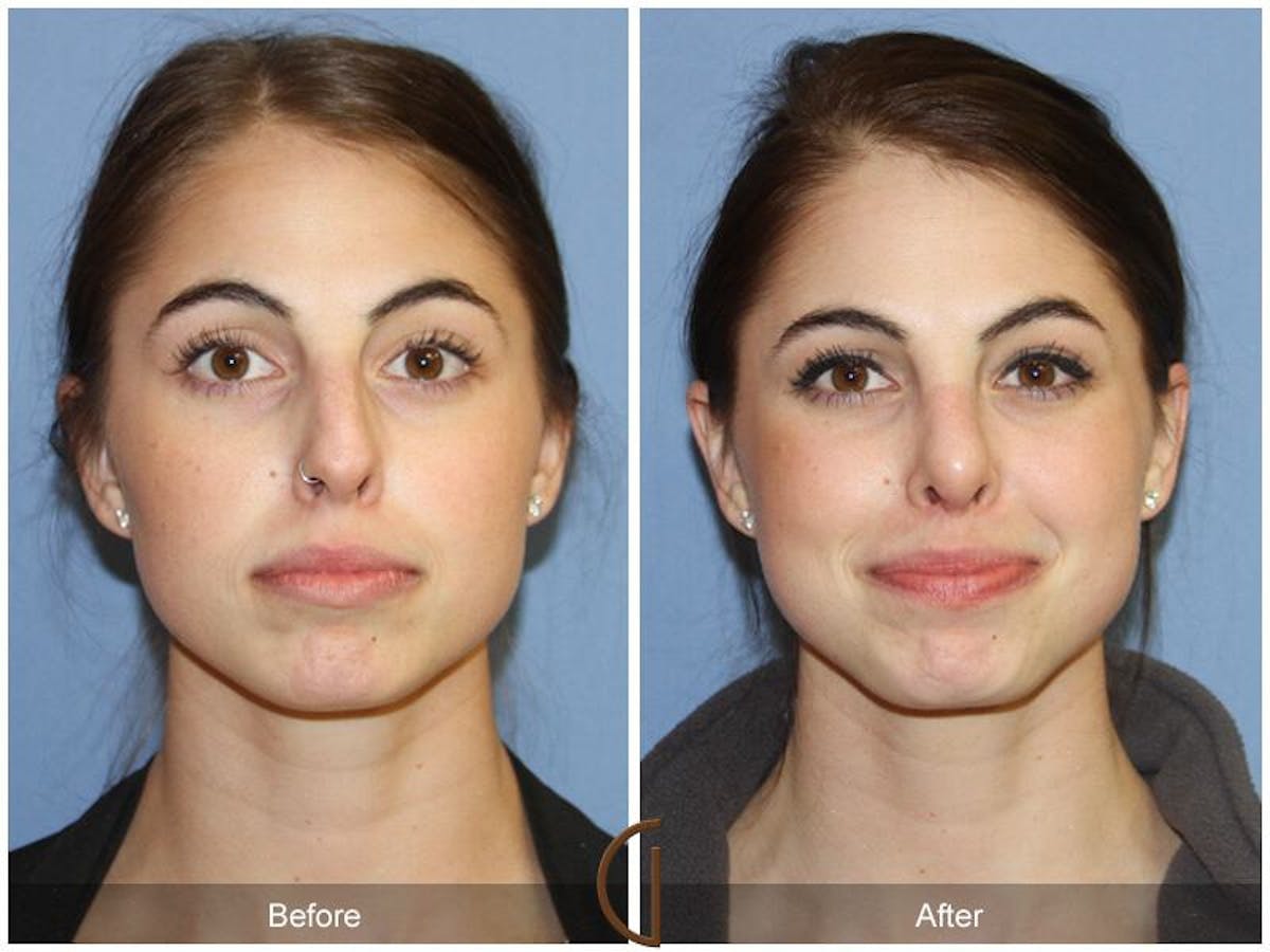 Female Rhinoplasty Before & After Gallery - Patient 613022 - Image 2