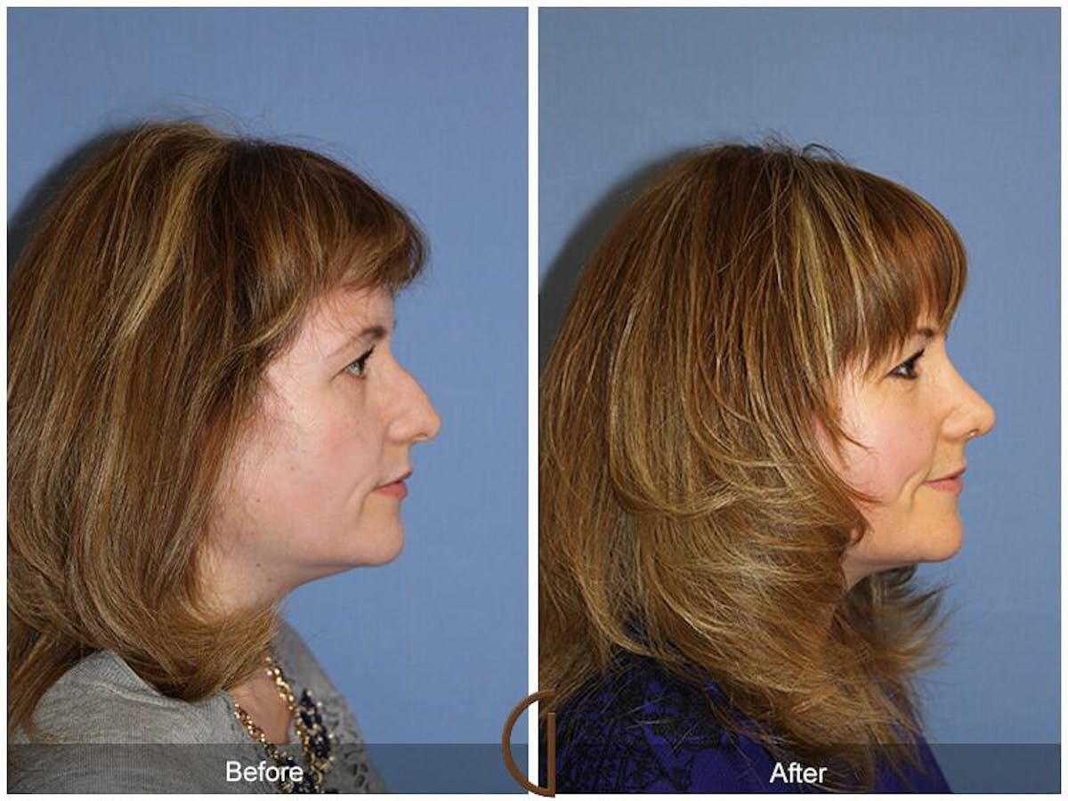 Female Rhinoplasty Before & After Gallery - Patient 116686 - Image 3