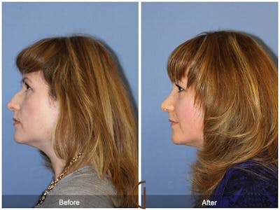 Female Rhinoplasty Before & After Gallery - Patient 116686 - Image 1