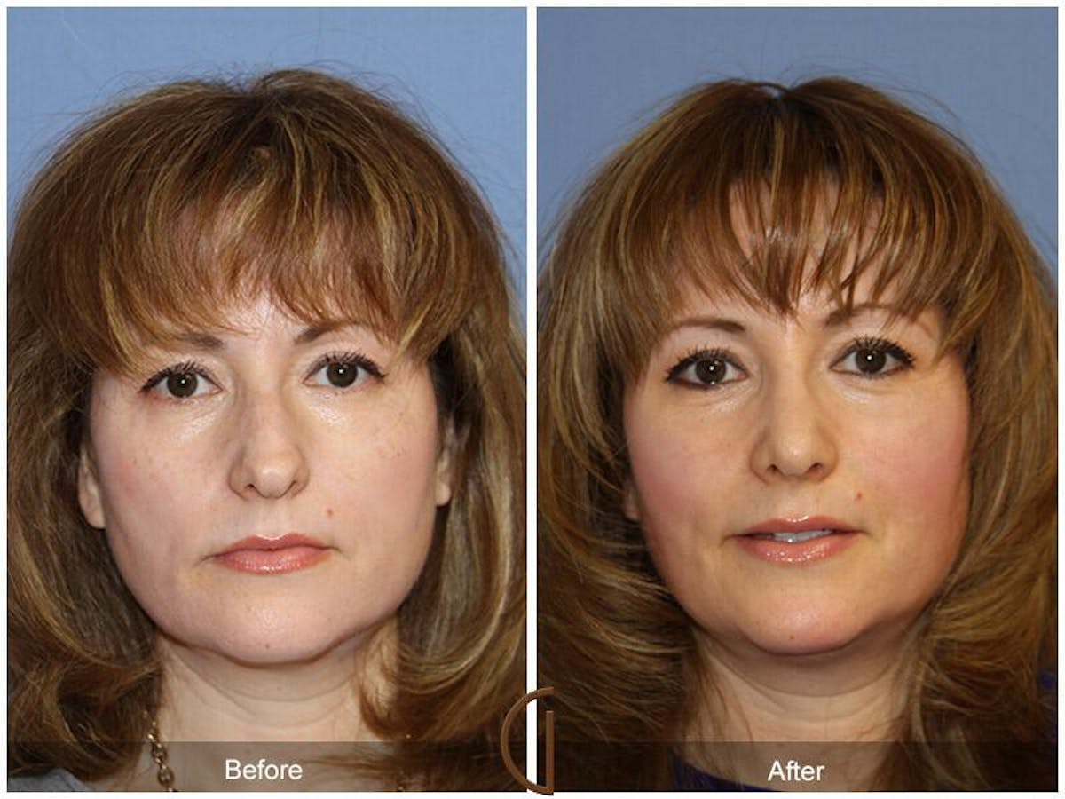 Female Rhinoplasty Before & After Gallery - Patient 116686 - Image 2
