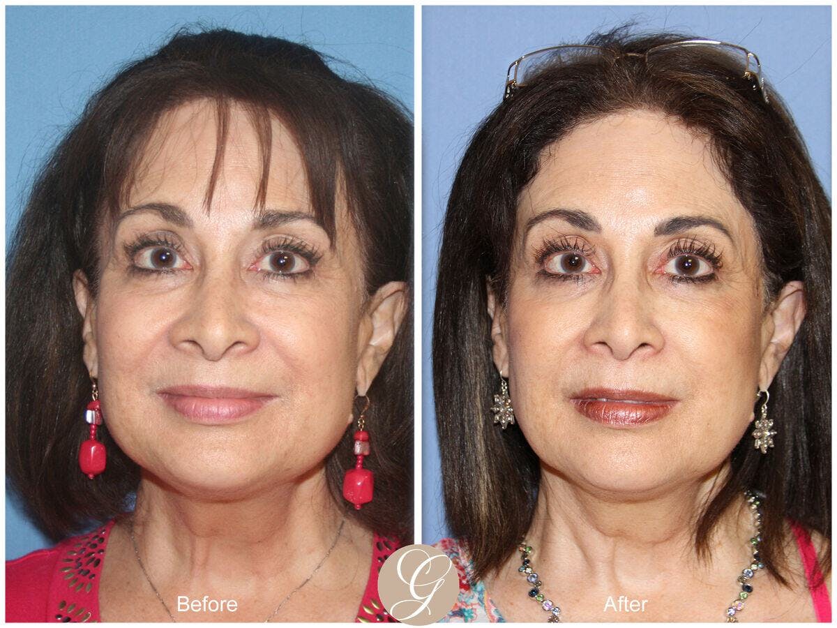 Female Rhinoplasty Before & After Gallery - Patient 252460 - Image 2