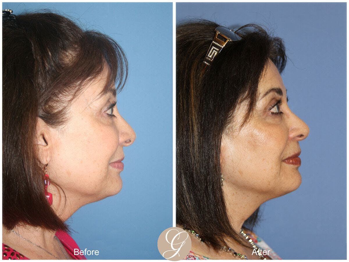 Female Rhinoplasty Before & After Gallery - Patient 252460 - Image 3