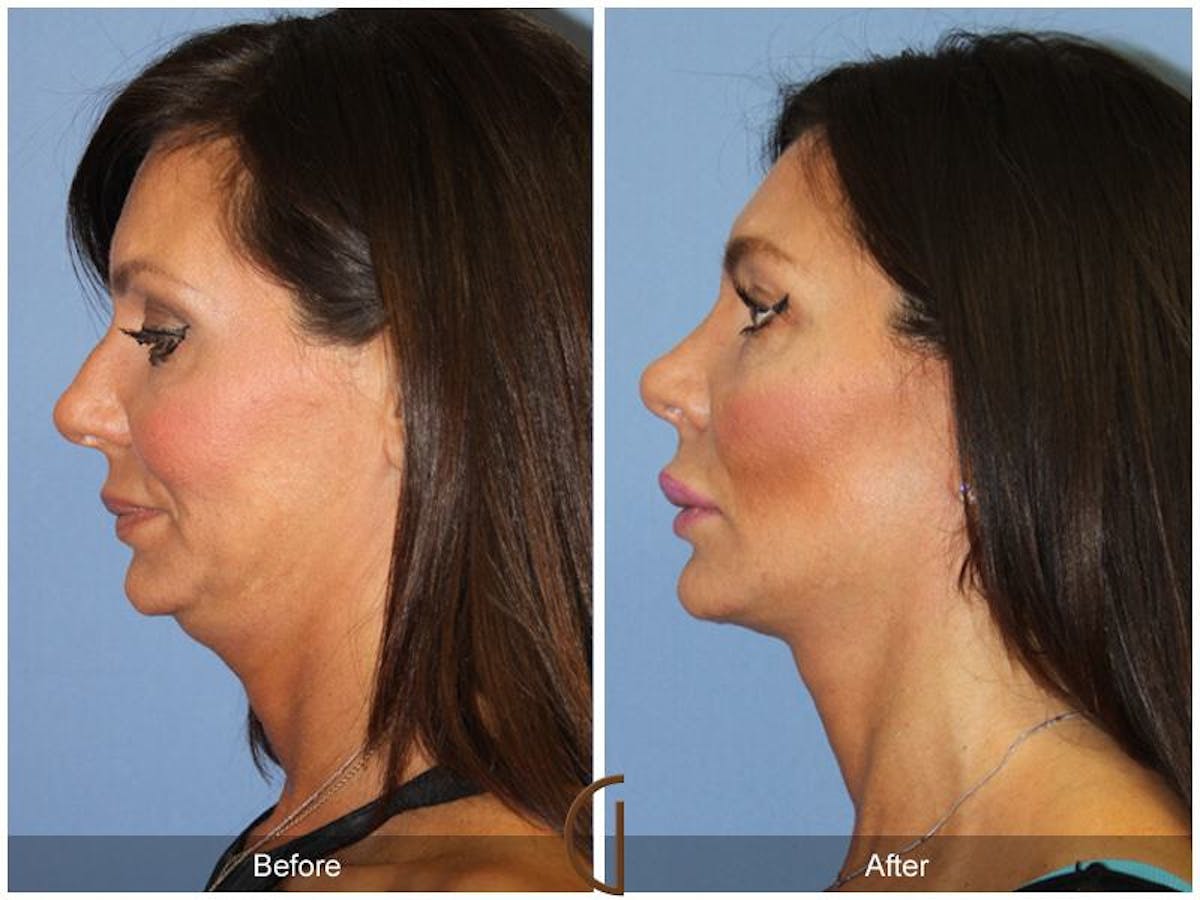 Female Rhinoplasty Before & After Gallery - Patient 344779 - Image 1
