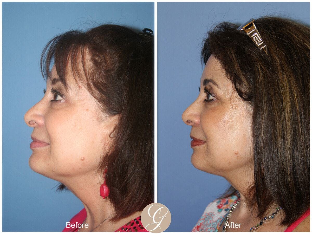 Female Rhinoplasty Before & After Gallery - Patient 252460 - Image 1