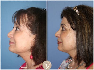 Female Rhinoplasty Before & After Gallery - Patient 252460 - Image 1