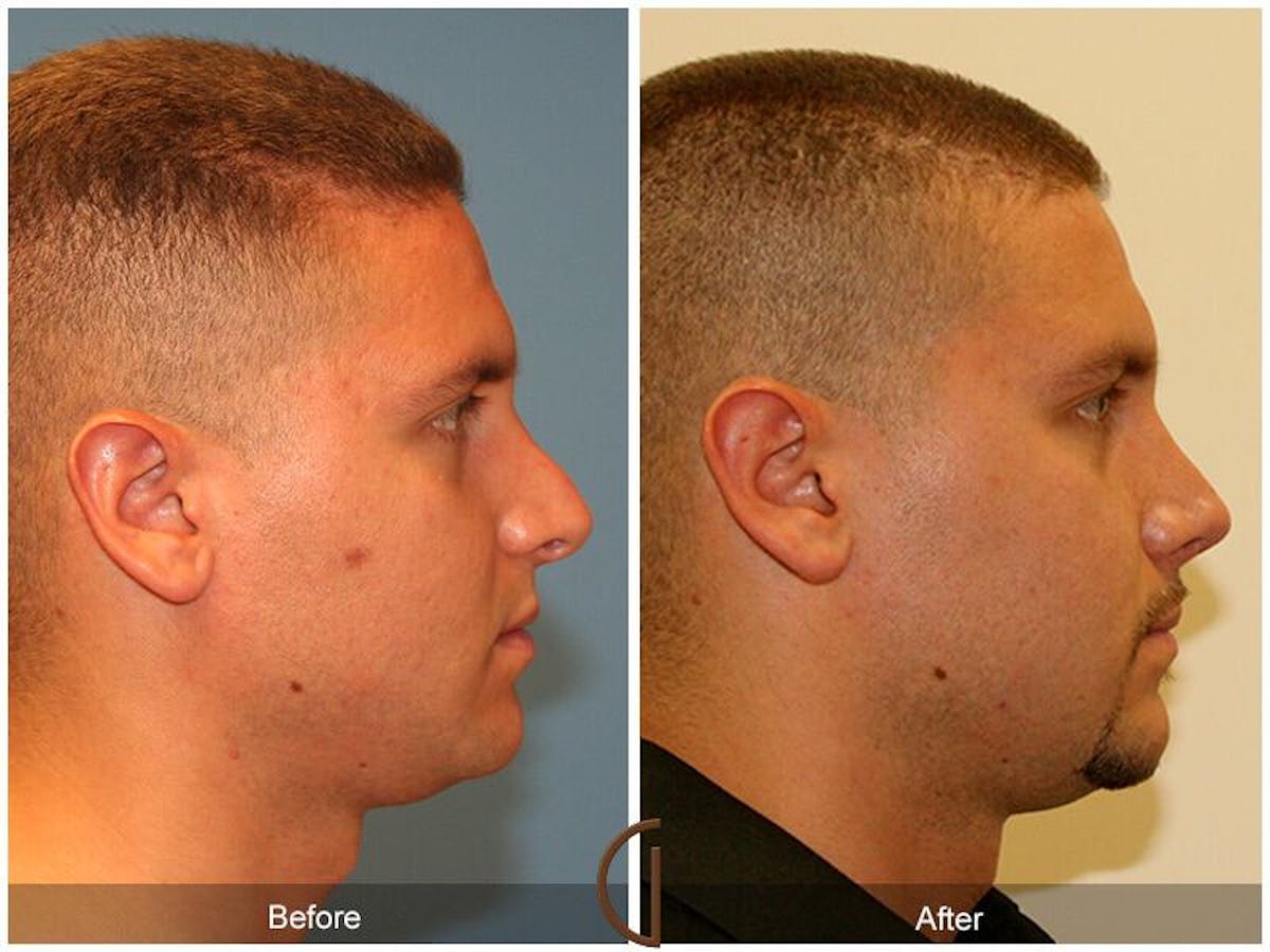Revision Rhinoplasty Before & After Gallery - Patient 259199 - Image 3
