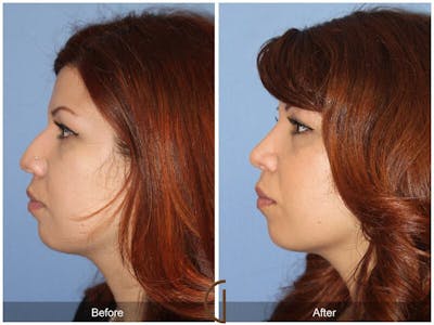 Female Rhinoplasty Before & After Gallery - Patient 228641 - Image 1