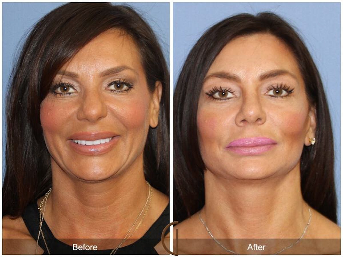 Female Rhinoplasty Before & After Gallery - Patient 344779 - Image 2