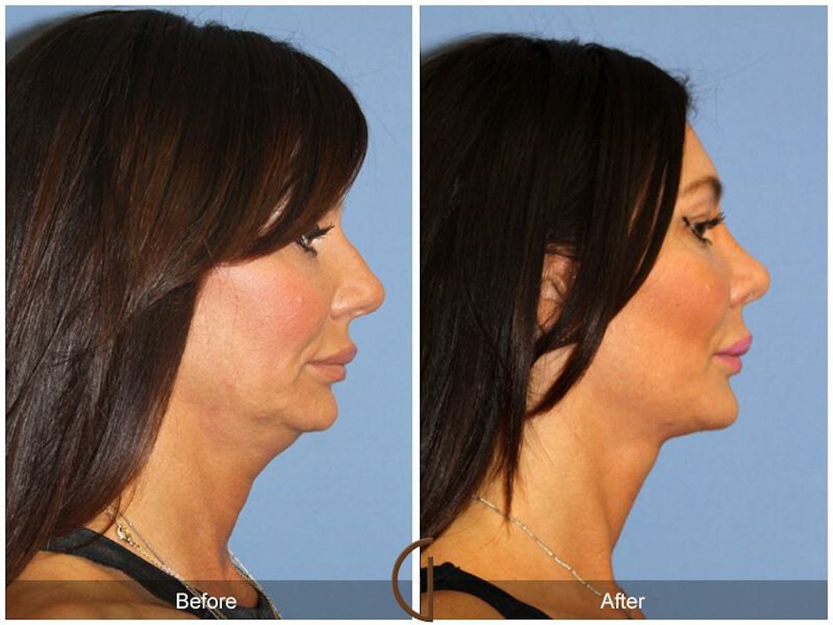 Female Rhinoplasty Before & After Gallery - Patient 344779 - Image 3