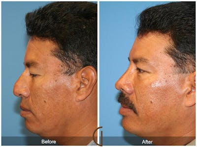 Male Rhinoplasty Before & After Gallery - Patient 335185 - Image 1
