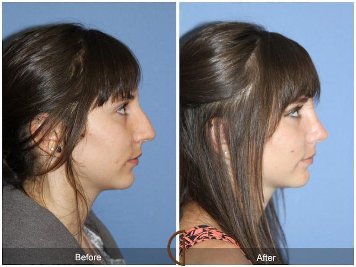 Female Rhinoplasty Before & After Gallery - Patient 346899 - Image 3
