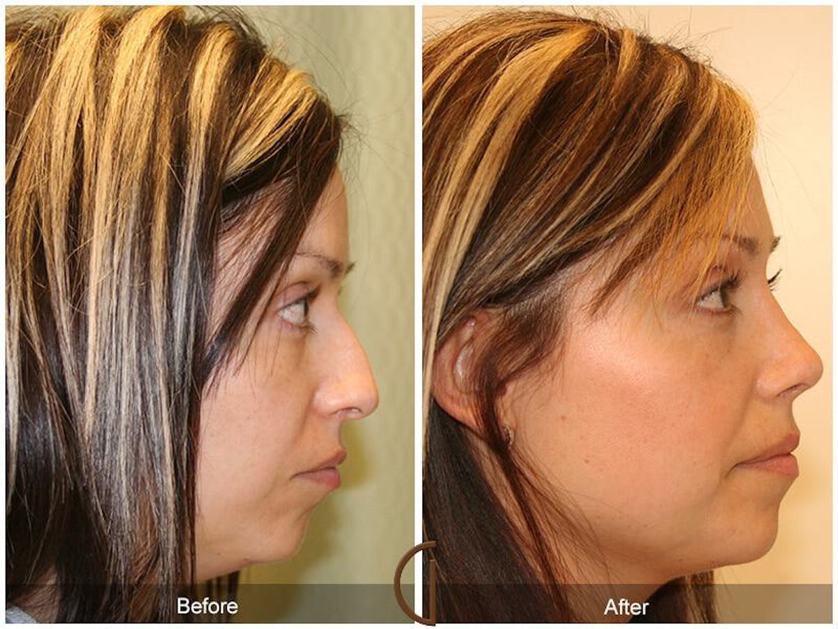 Female Rhinoplasty Before & After Gallery - Patient 151238 - Image 3