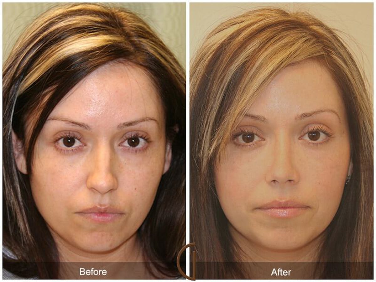 Female Rhinoplasty Before & After Gallery - Patient 151238 - Image 2