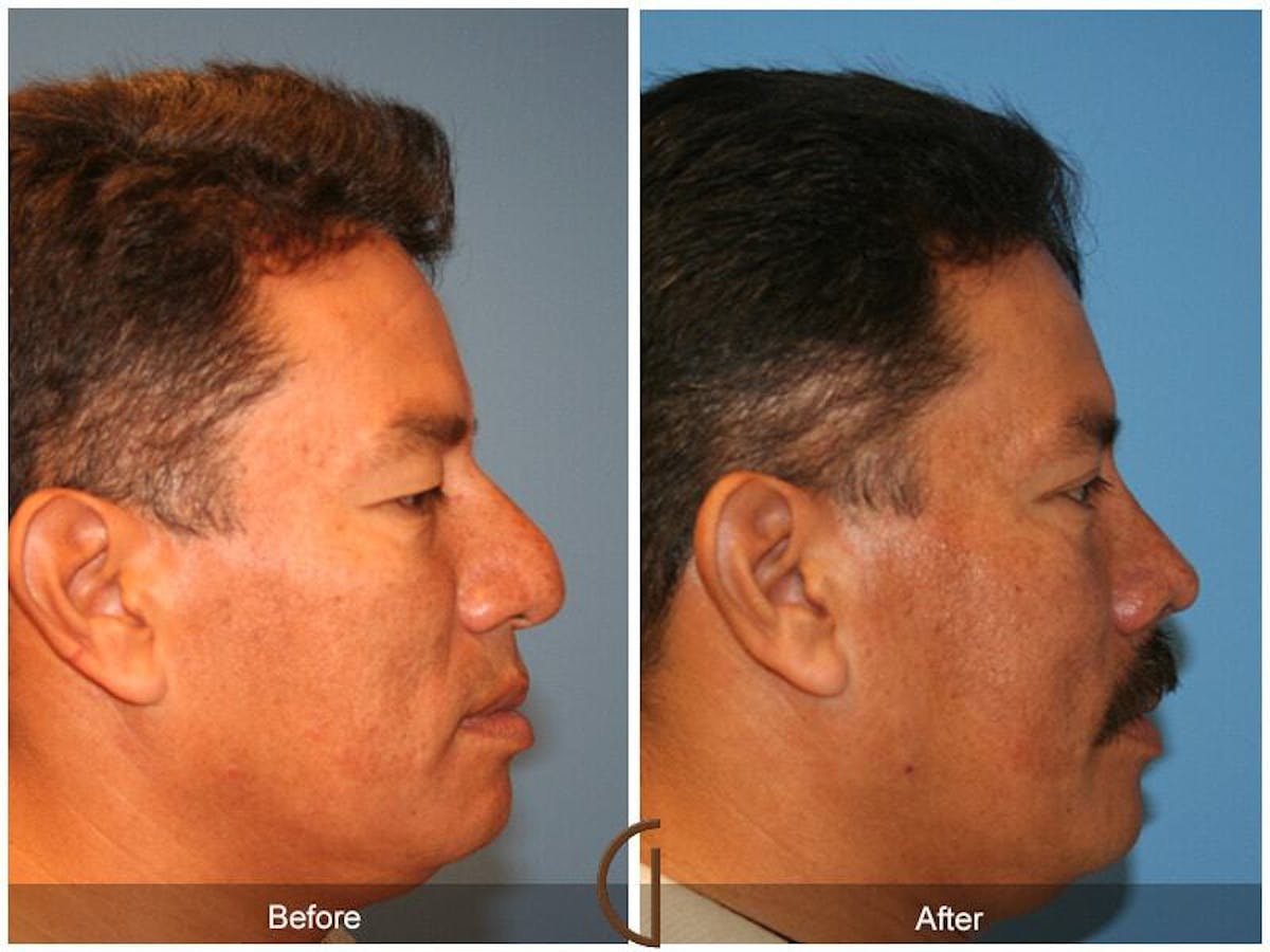 Male Rhinoplasty Before & After Gallery - Patient 335185 - Image 3