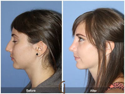Female Rhinoplasty Before & After Gallery - Patient 346899 - Image 1