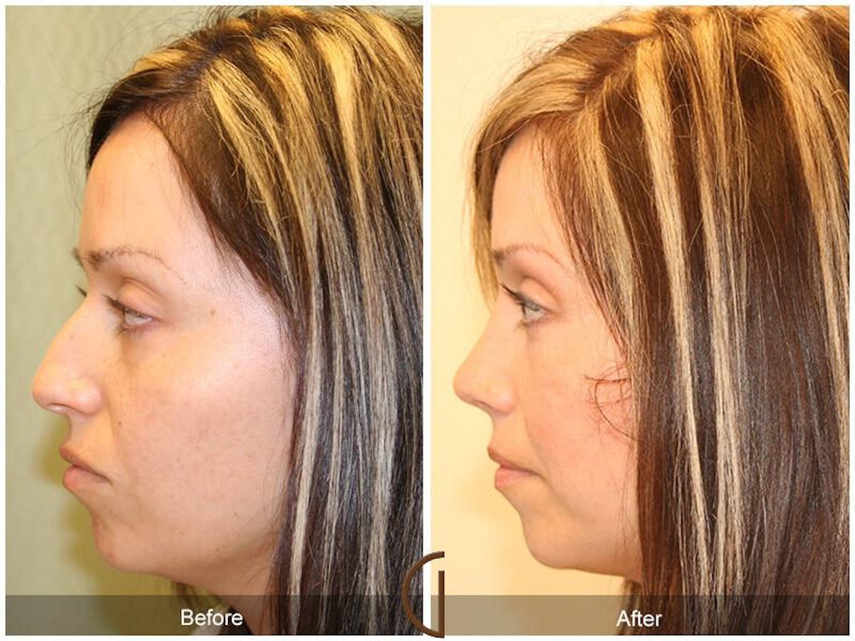 Female Rhinoplasty Before & After Gallery - Patient 151238 - Image 1
