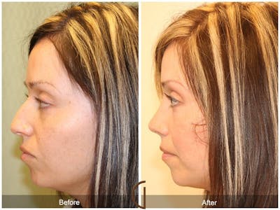 Female Rhinoplasty Before & After Gallery - Patient 151238 - Image 1