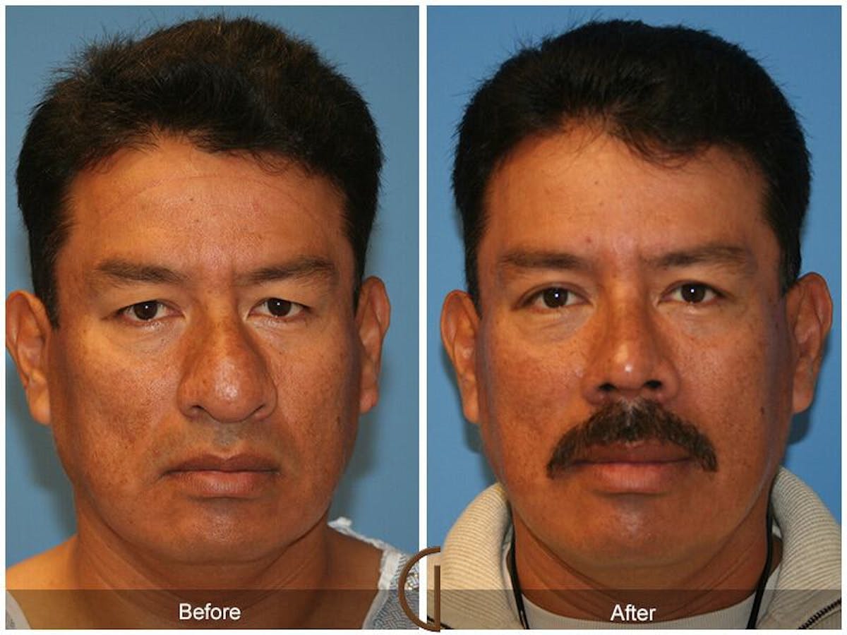 Male Rhinoplasty Before & After Gallery - Patient 335185 - Image 2