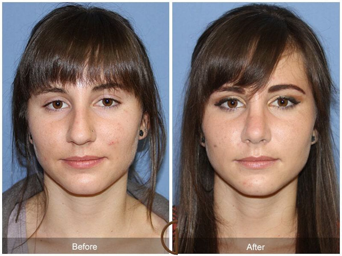 Female Rhinoplasty Before & After Gallery - Patient 346899 - Image 2