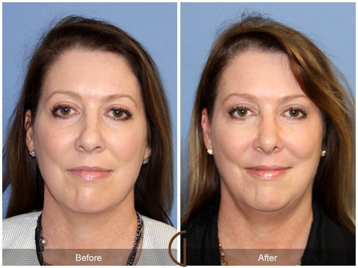 Female Rhinoplasty Before & After Gallery - Patient 697202 - Image 2