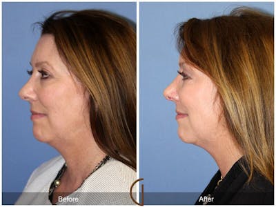 Female Rhinoplasty Before & After Gallery - Patient 697202 - Image 1