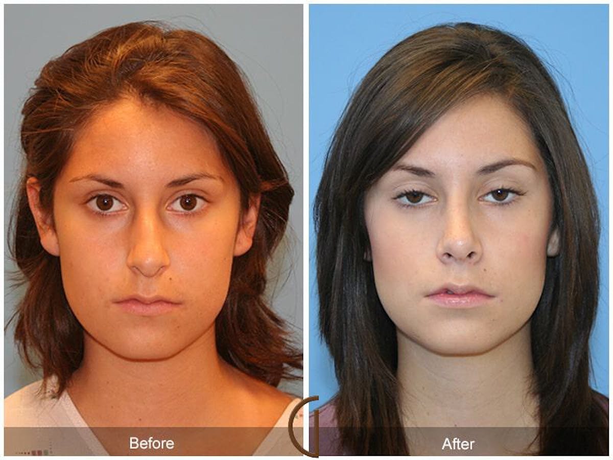 Ethnic Rhinoplasty Before & After Gallery - Patient 330491 - Image 2