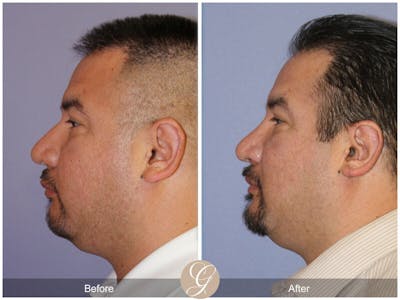 Male Rhinoplasty Before & After Gallery - Patient 215273 - Image 1