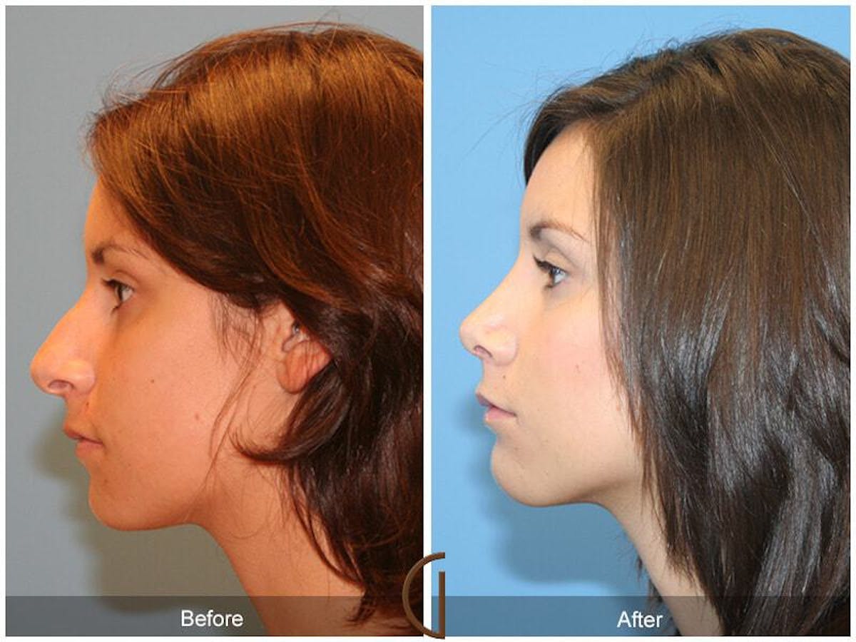 Ethnic Rhinoplasty Before & After Gallery - Patient 330491 - Image 1
