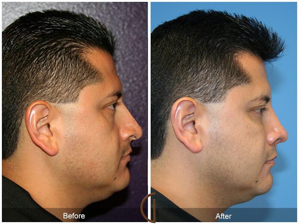Male Rhinoplasty Before & After Gallery - Patient 317754 - Image 3