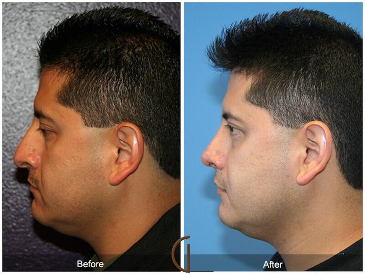 Male Rhinoplasty Before & After Gallery - Patient 317754 - Image 1