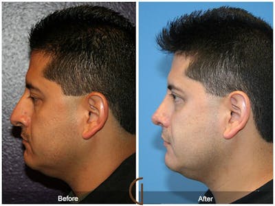 Male Rhinoplasty Before & After Gallery - Patient 317754 - Image 1