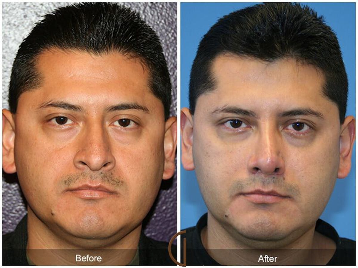 Male Rhinoplasty Before & After Gallery - Patient 317754 - Image 2