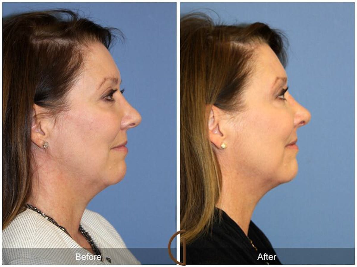 Female Rhinoplasty Before & After Gallery - Patient 697202 - Image 3
