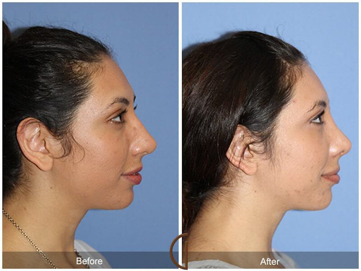Female Rhinoplasty Before & After Gallery - Patient 234514 - Image 3