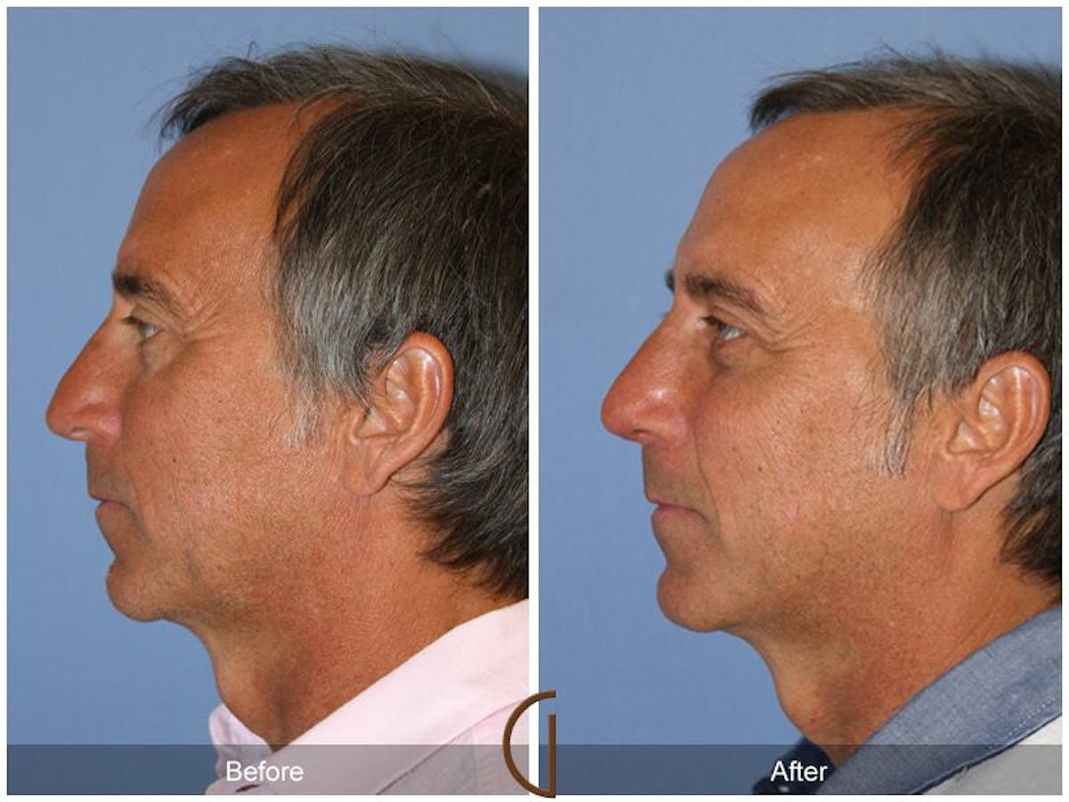 Rhinoplasty Before & After Gallery - Patient 739157 - Image 1