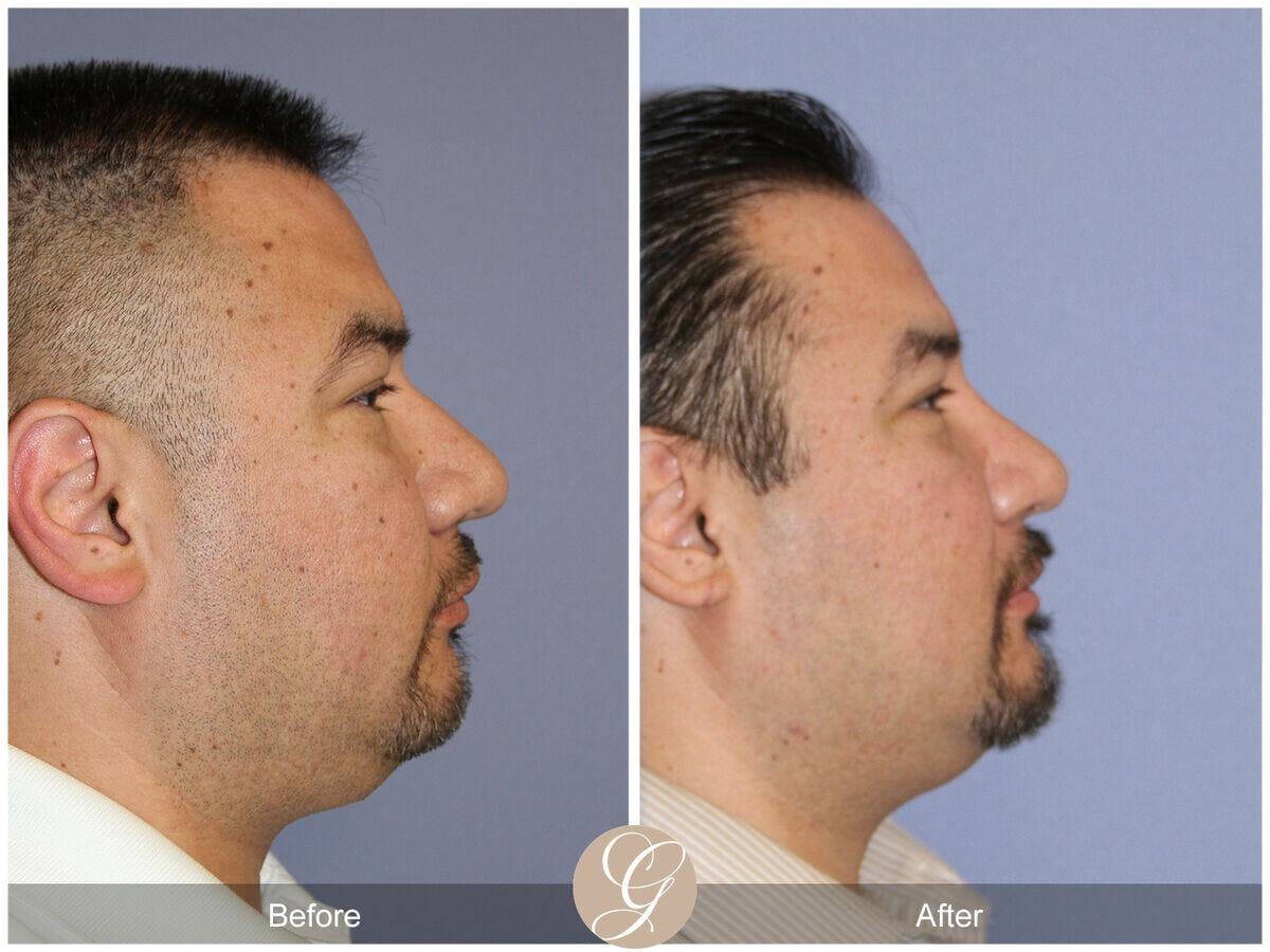 Male Rhinoplasty Before & After Gallery - Patient 215273 - Image 3
