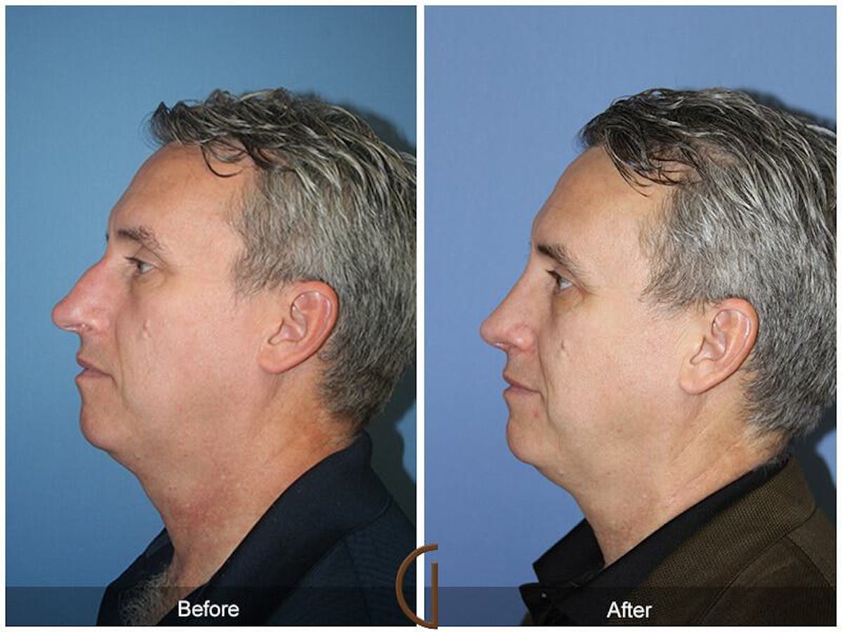 Rhinoplasty Before & After Gallery - Patient 329179 - Image 1