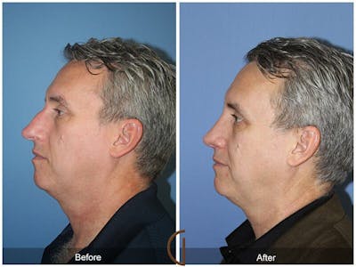 Rhinoplasty Before & After Gallery - Patient 329179 - Image 1