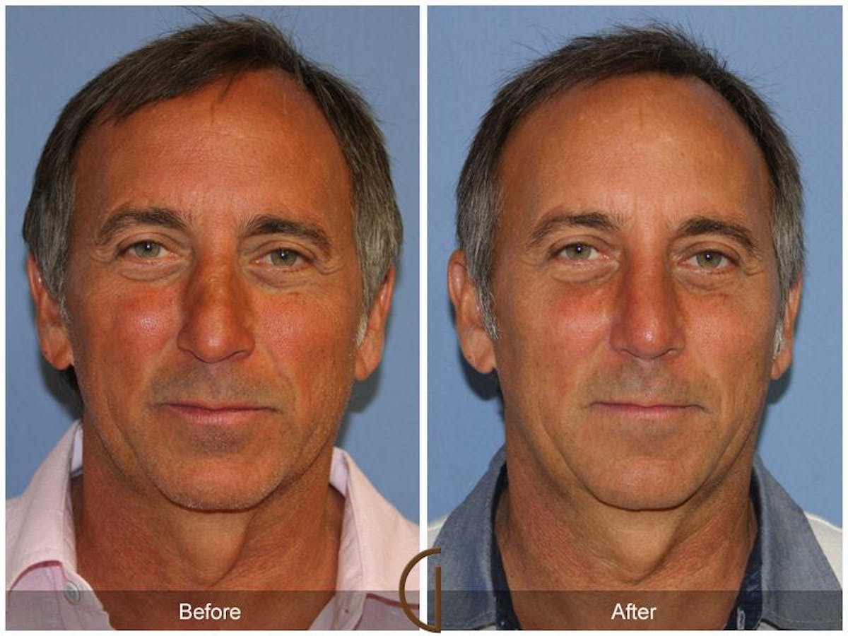 Rhinoplasty Before & After Gallery - Patient 739157 - Image 2